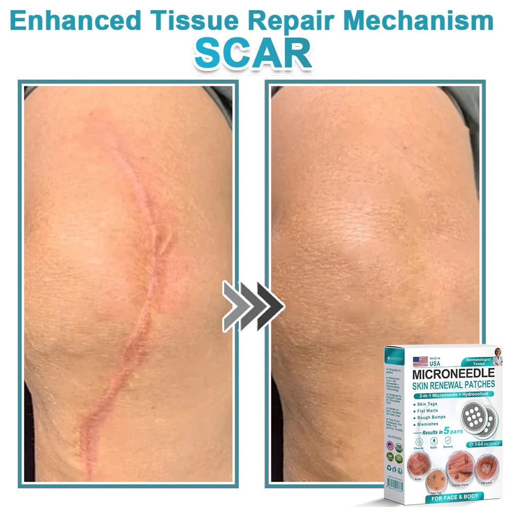 2-in-1 Microneedle & Hydrocolloid Patch👨⚕️ | Removes raised moles, acne, flat warts, and skin tags