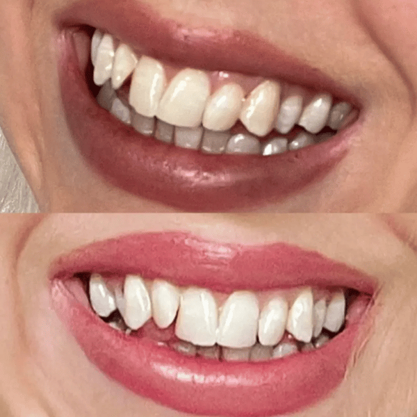 ✨Teeth Whitening Powder – Advanced PAP+ Formula for a Radiant, Healthy Smile