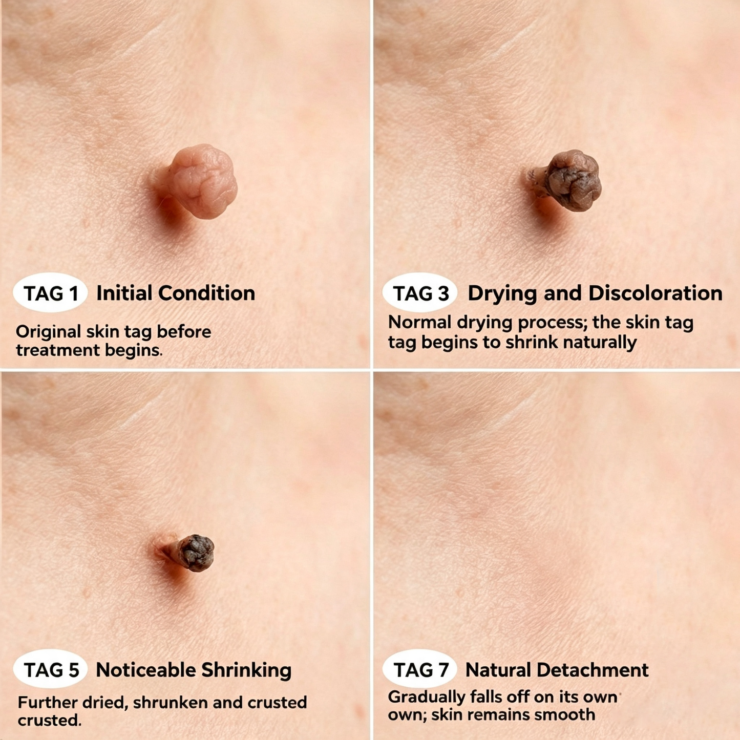 7-Day Skin Tag & Stain Remover