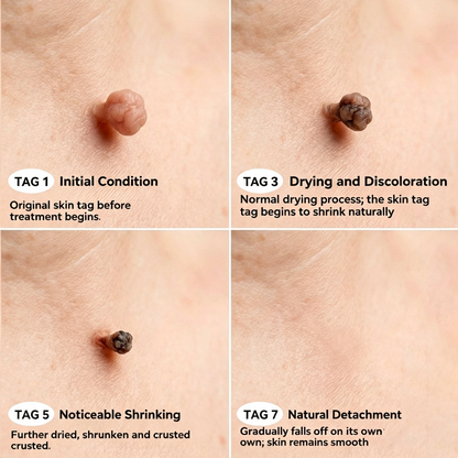 7-Day Skin Tag & Stain Remover