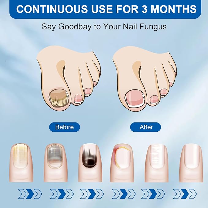 Rapid Clear Nail Fungus Laser Device: Eliminate Stubborn Onychomycosis Fast