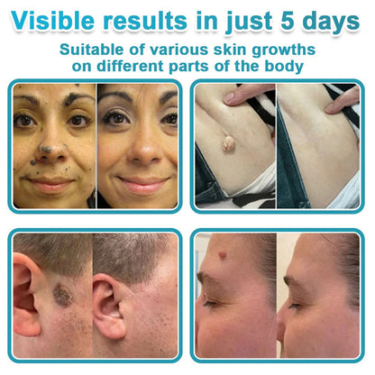 🌿2-in-1 Microneedle & Hydrocolloid Patch👨‍⚕️ | Removes raised moles, acne, flat warts, and skin tags