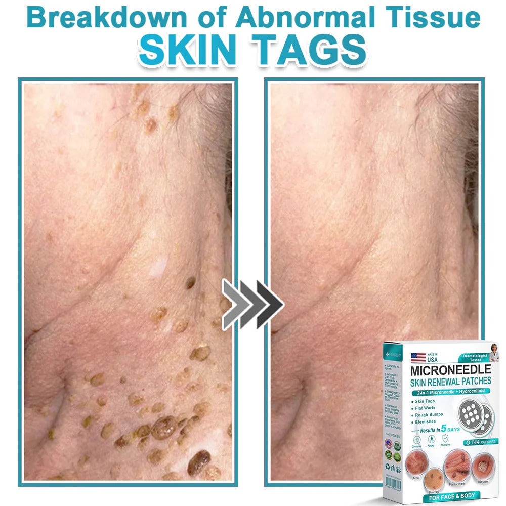 🌿2-in-1 Microneedle & Hydrocolloid Patch👨‍⚕️ | Removes raised moles, acne, flat warts, and skin tags
