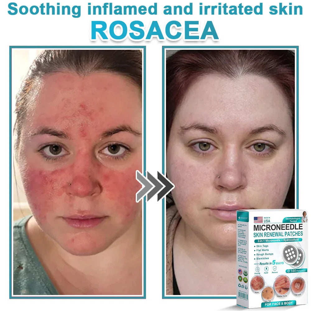 🌿2-in-1 Microneedle & Hydrocolloid Patch👨‍⚕️ | Removes raised moles, acne, flat warts, and skin tags