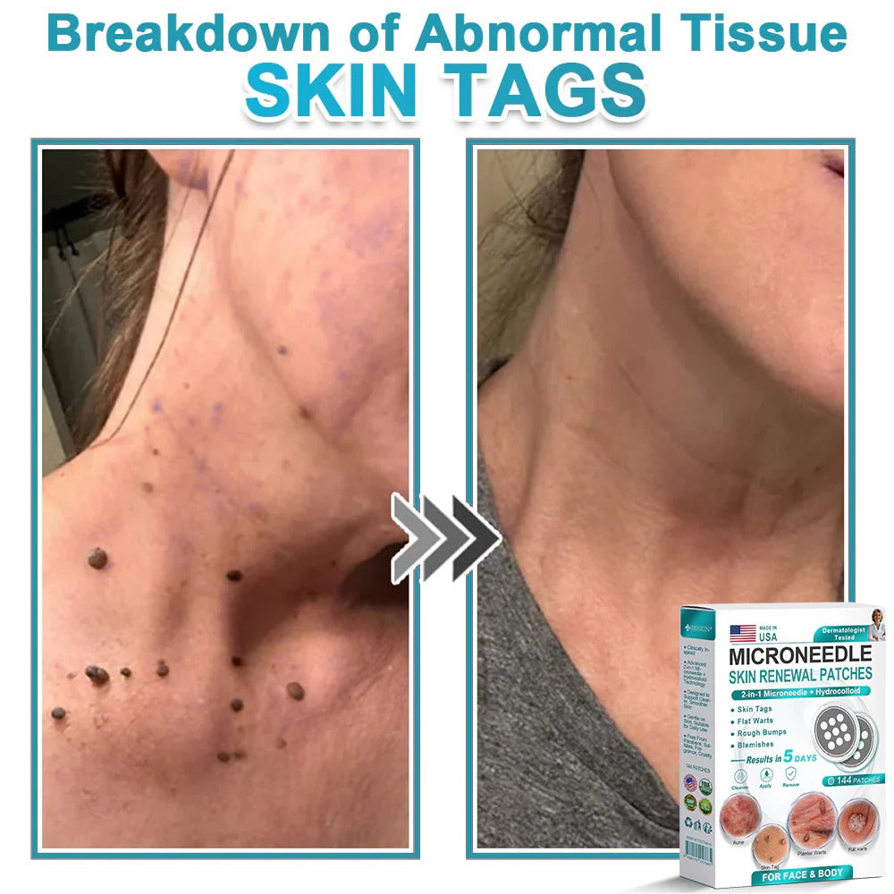 🌿2-in-1 Microneedle & Hydrocolloid Patch👨‍⚕️ | Removes raised moles, acne, flat warts, and skin tags