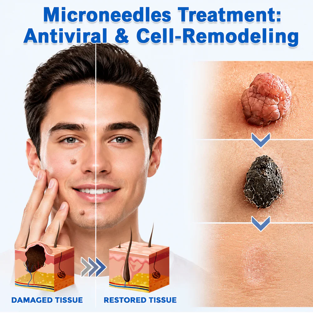 🌿2-in-1 Microneedle & Hydrocolloid Patch👨‍⚕️ | Removes raised moles, acne, flat warts, and skin tags