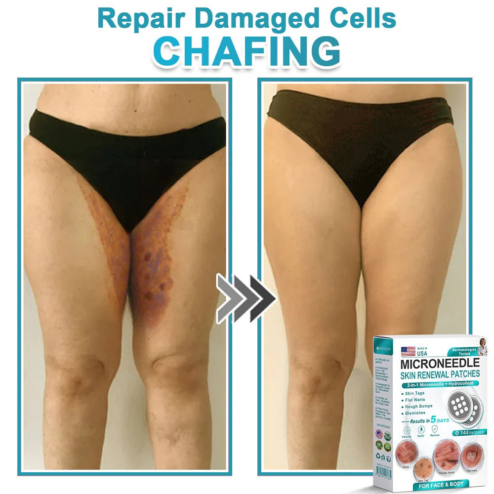 🌿2-in-1 Microneedle & Hydrocolloid Patch👨‍⚕️ | Removes raised moles, acne, flat warts, and skin tags