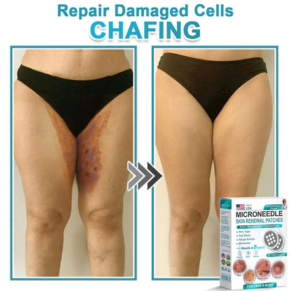 🌿2-in-1 Microneedle & Hydrocolloid Patch👨‍⚕️ | Removes raised moles, acne, flat warts, and skin tags