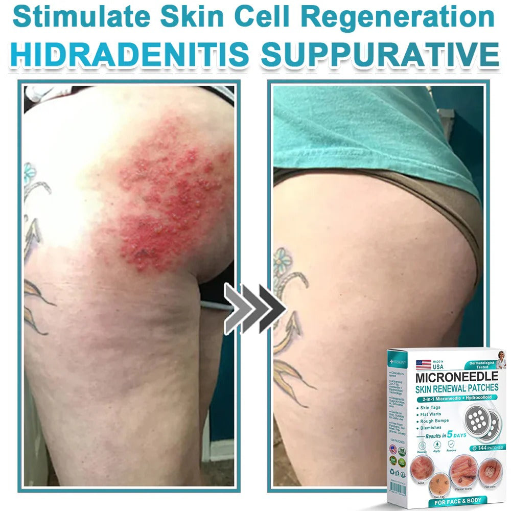 🌿2-in-1 Microneedle & Hydrocolloid Patch👨‍⚕️ | Removes raised moles, acne, flat warts, and skin tags