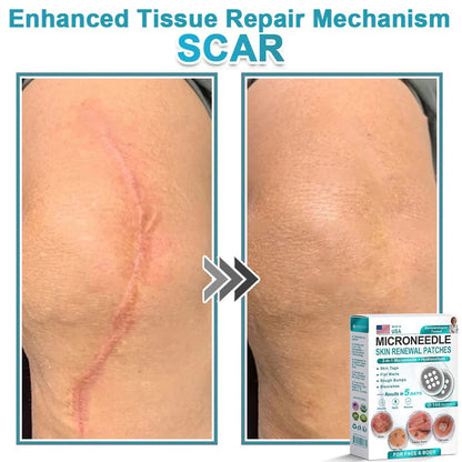 🌿2-in-1 Microneedle & Hydrocolloid Patch👨‍⚕️ | Removes raised moles, acne, flat warts, and skin tags
