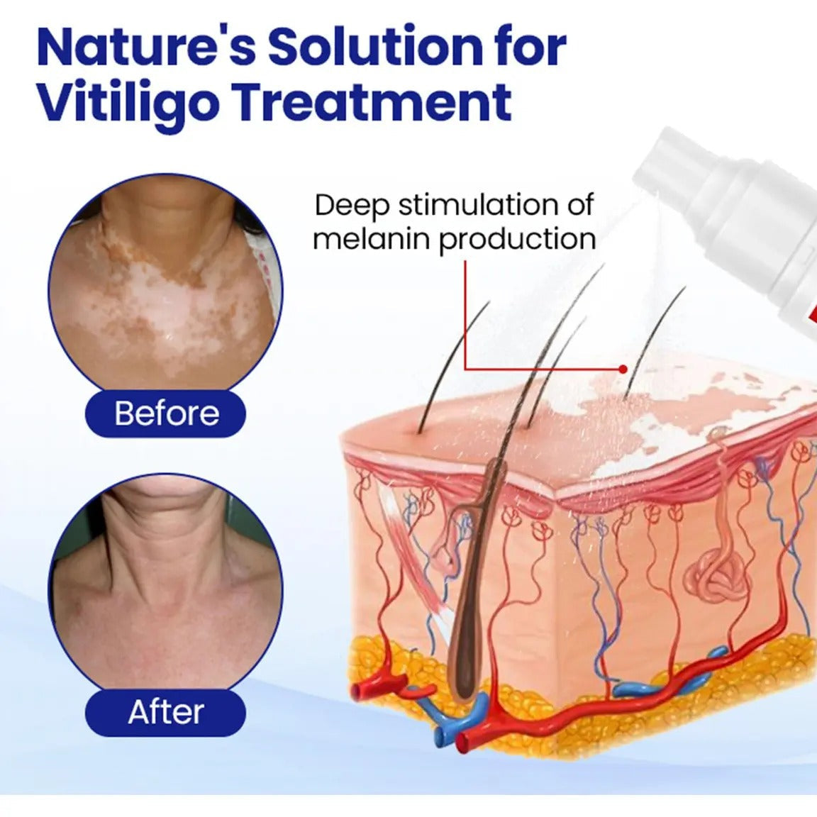 Vitiligo Treatment Spray-Professional White Spot Remover
