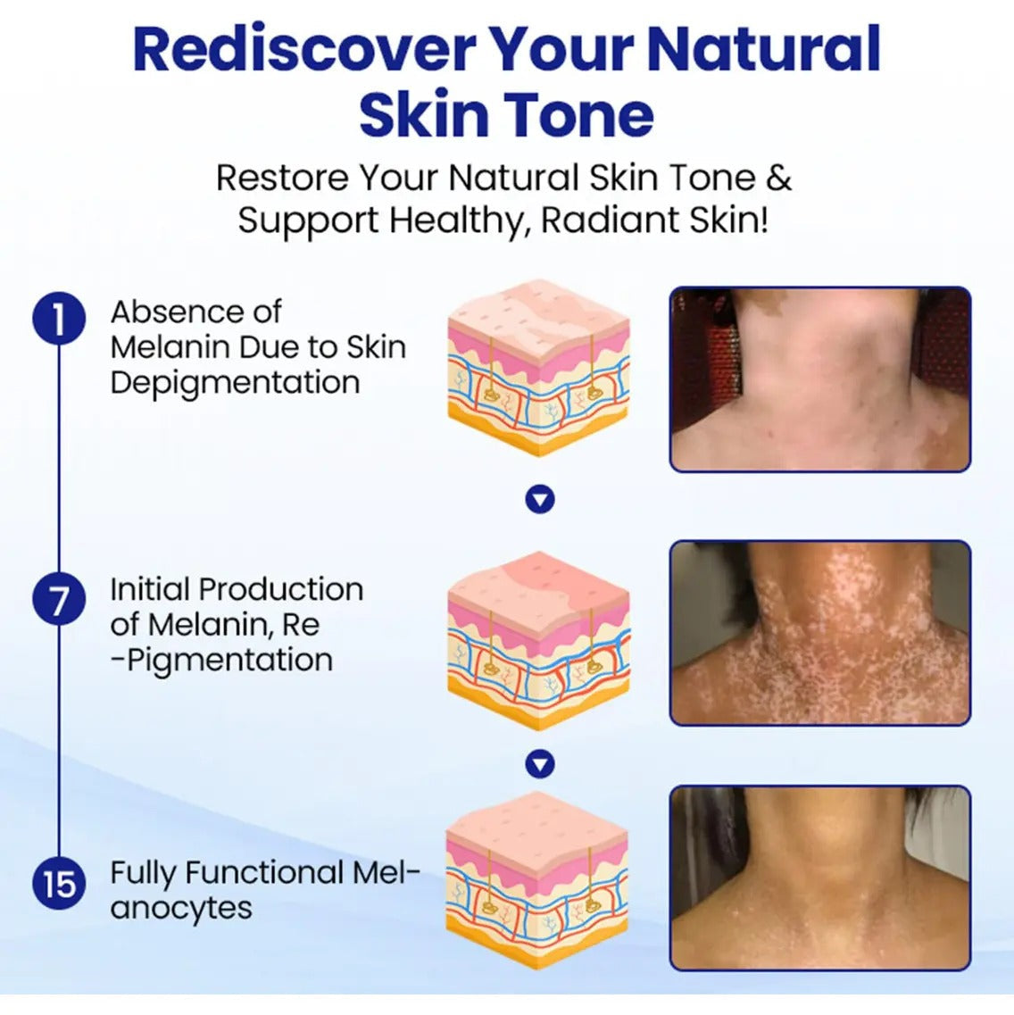 Vitiligo Treatment Spray-Professional White Spot Remover