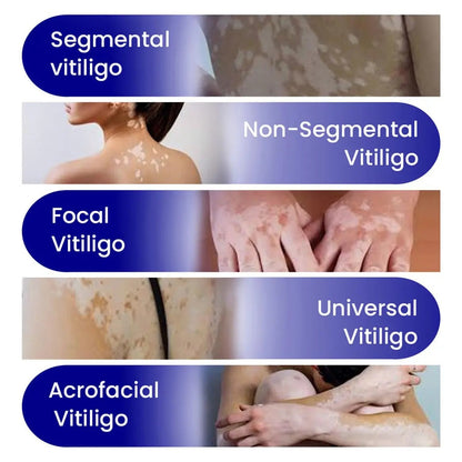 Vitiligo Treatment Spray-Professional White Spot Remover